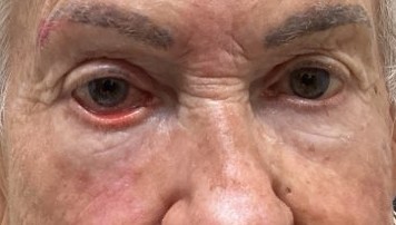 Clinical example of lower eyelid ectropion
