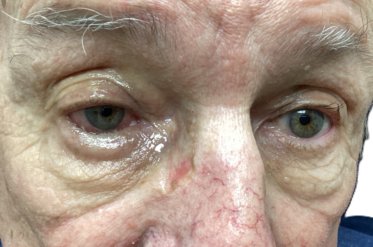Clinical example of lower eyelid entropion