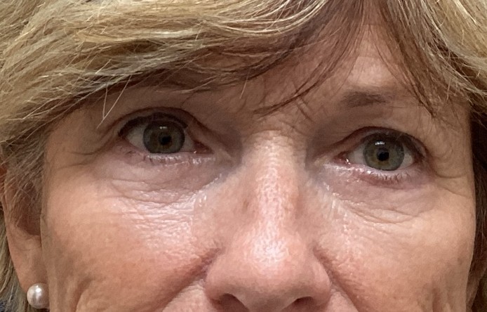 After upper and lower blepharoplasty
