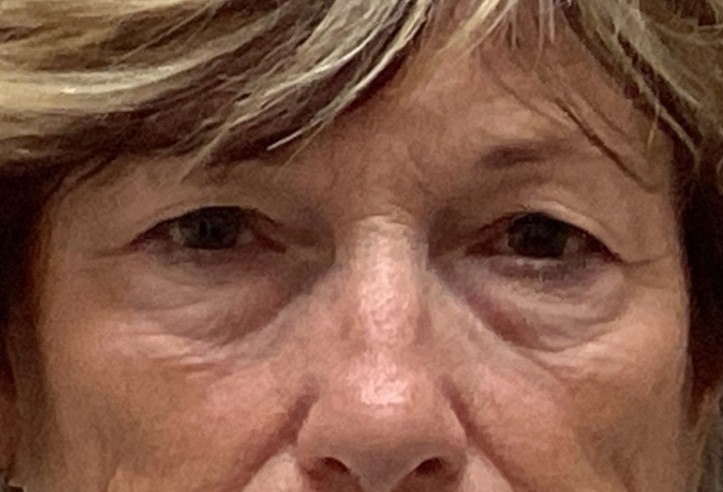 Before upper and lower blepharoplasty