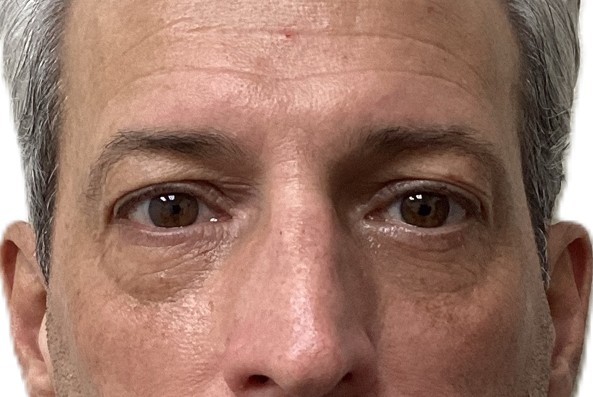 After lower blepharoplasty