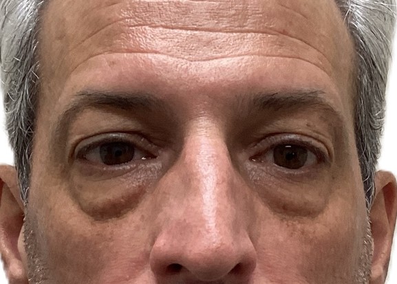 Before lower blepharoplasty