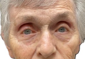 After ptosis repair