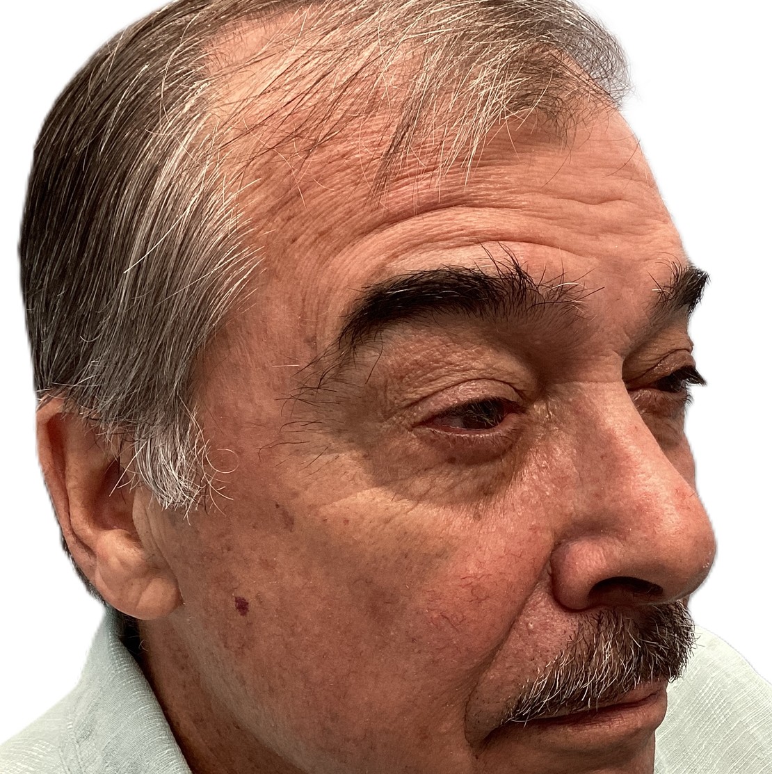 Patient after eyelid reconstruction