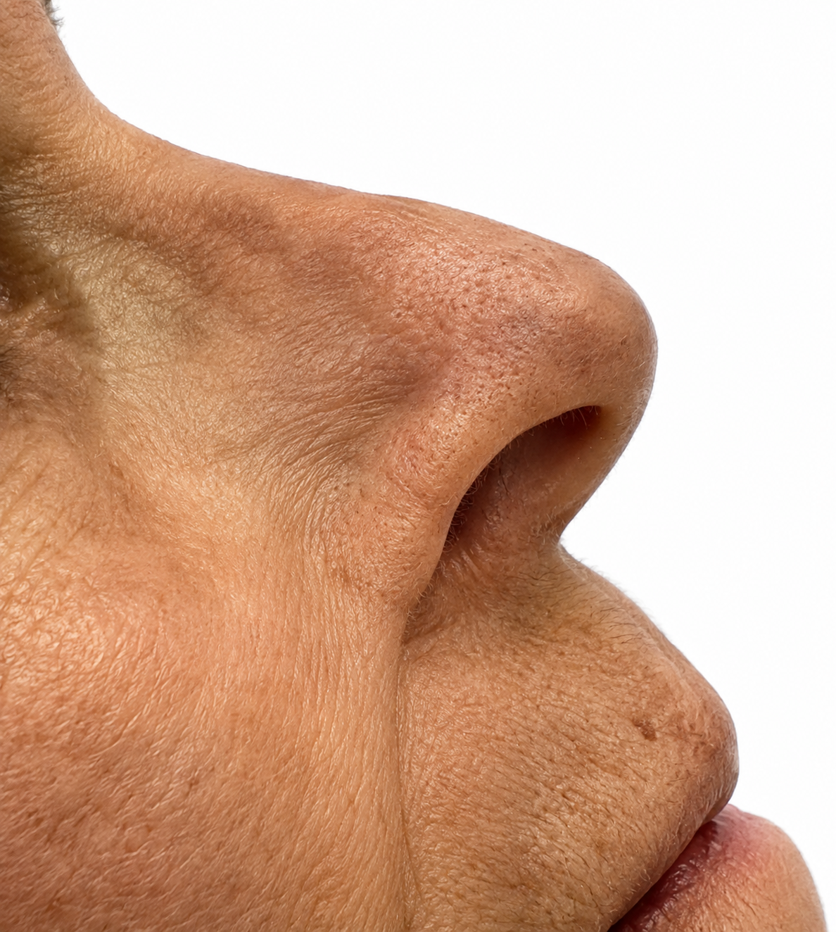After facial reconstruction