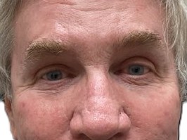 After Upper Blepharoplasty & Brow Procedure