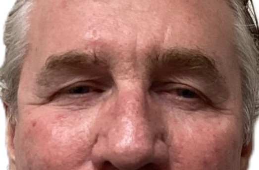 Before Upper Blepharoplasty & Brow Procedure