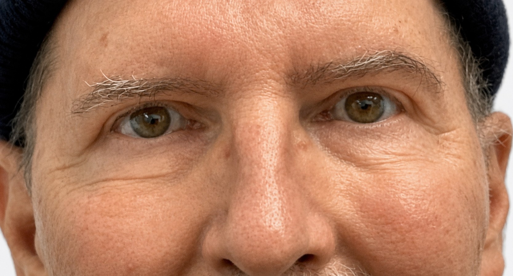 After Upper Blepharoplasty & Brow Procedure