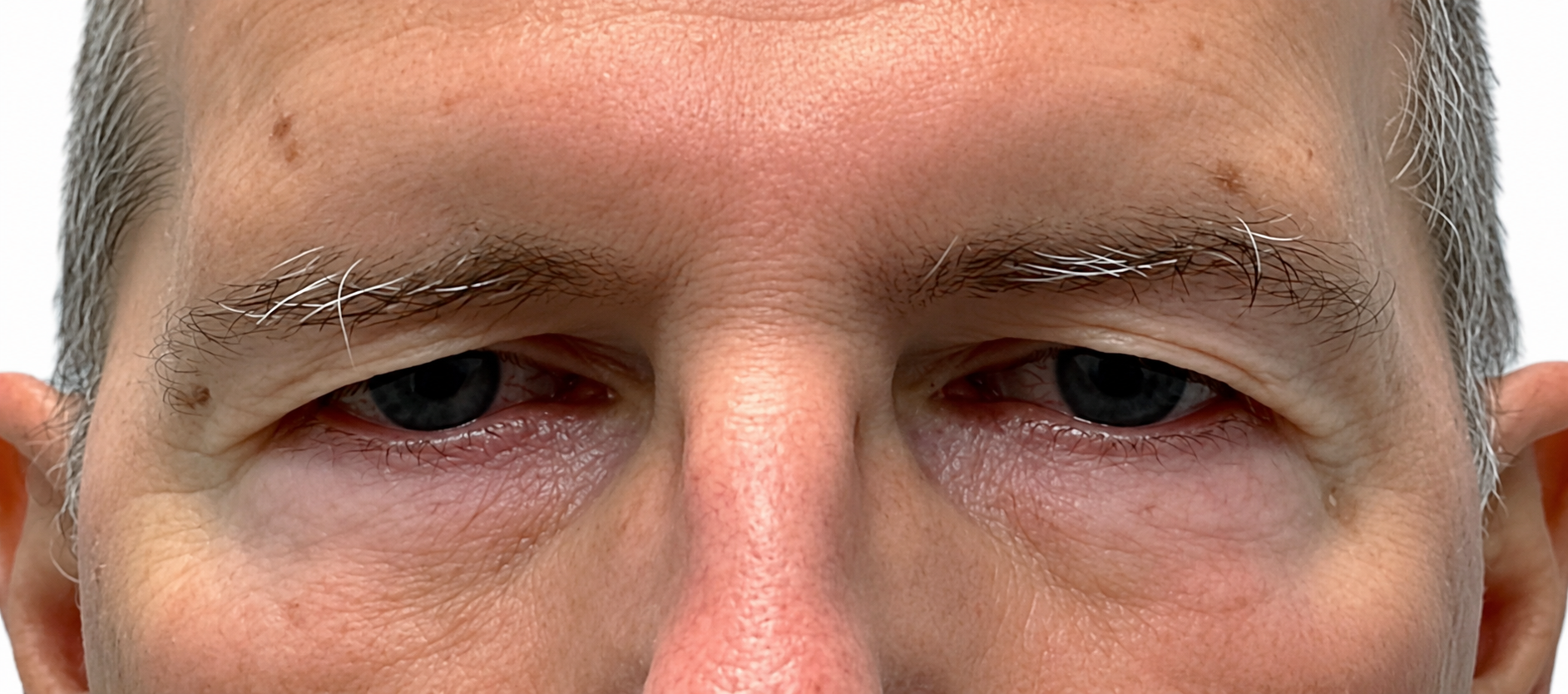 Before Upper Blepharoplasty & Brow Procedure