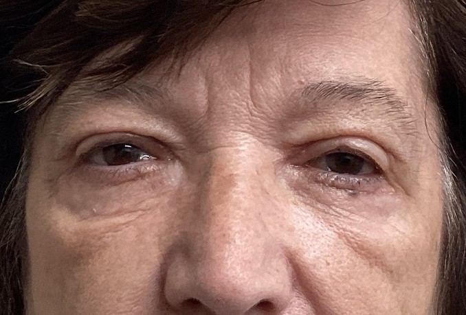 After Upper & Lower Blepharoplasty
