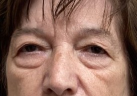 Before Upper & Lower Blepharoplasty