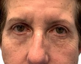 After Upper & Lower Blepharoplasty