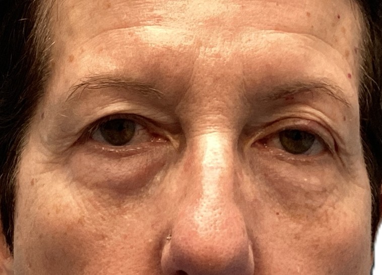 Before Upper & Lower Blepharoplasty