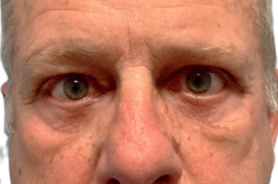 After Upper & Lower Blepharoplasty