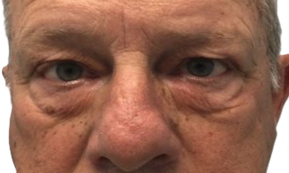Before Upper & Lower Blepharoplasty