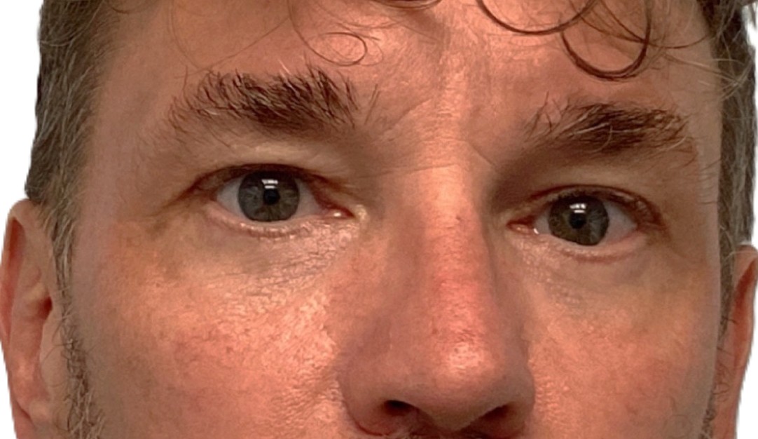After Lower Blepharoplasty