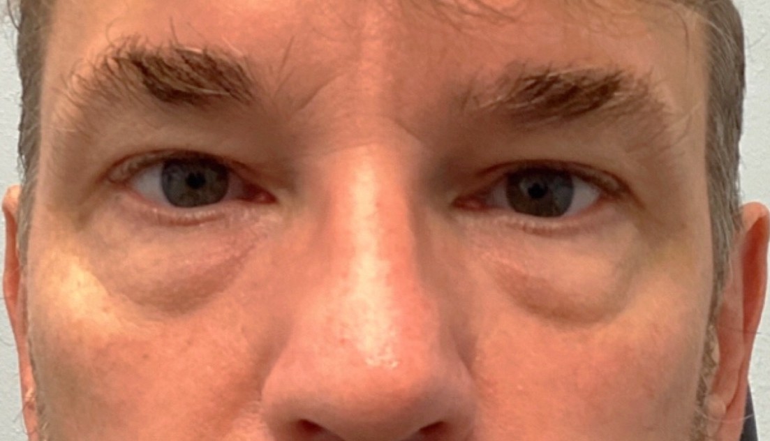 Before Lower Blepharoplasty