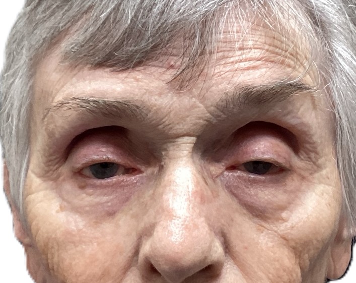 Before Ptosis Repair