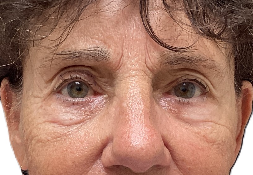 After Ptosis Repair