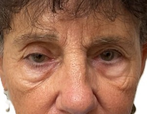 Before Ptosis Repair