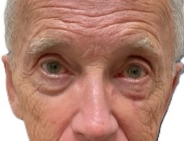 After Ptosis Repair
