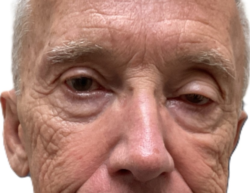 Before Ptosis Repair