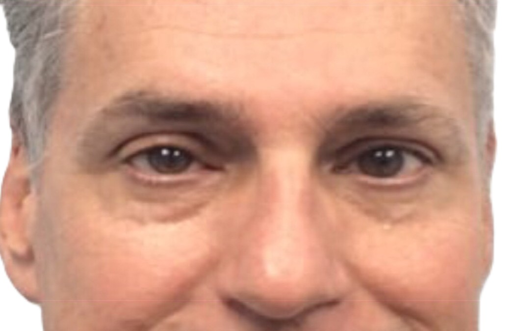 After Ptosis Repair
