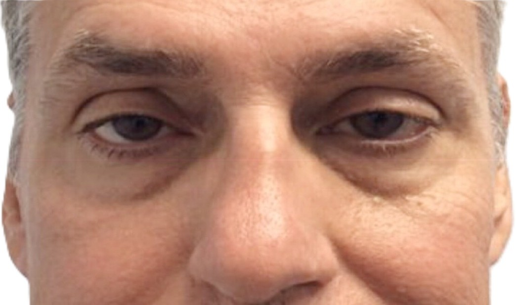 Before Ptosis Repair