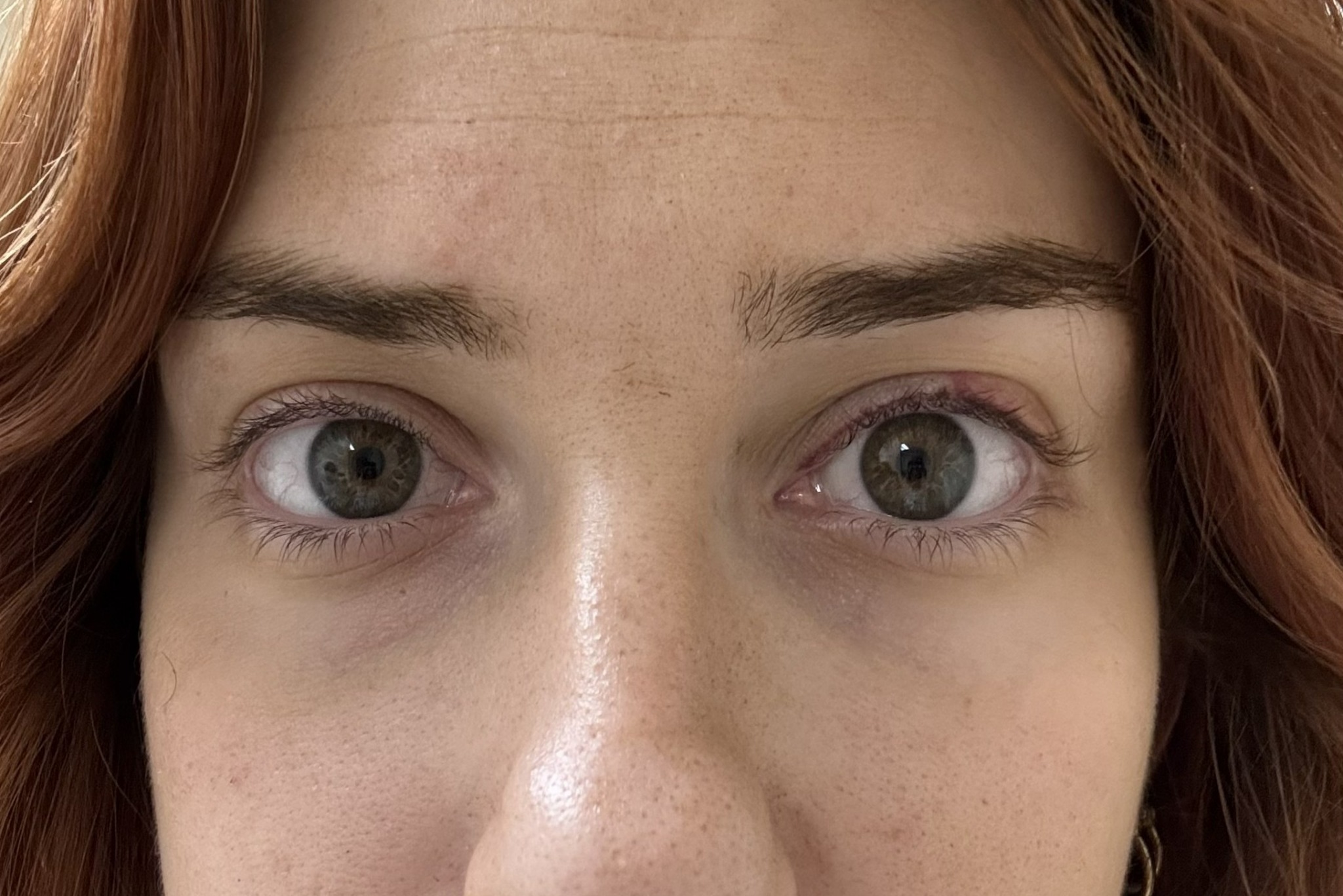 After Ptosis Repair