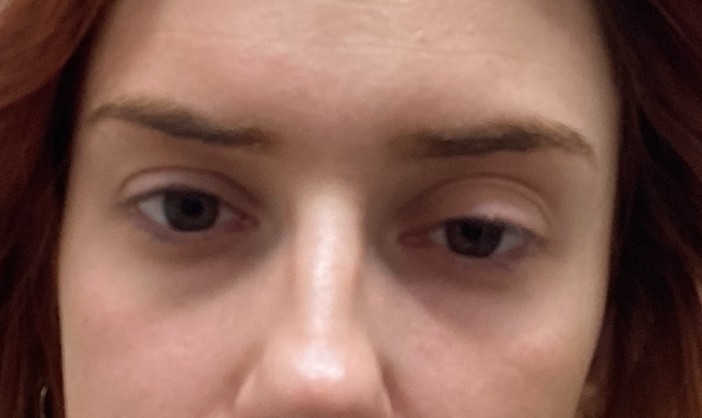 Before Ptosis Repair