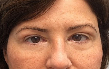 After Ptosis Repair