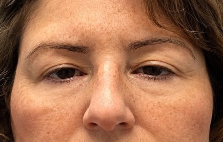 Before Ptosis Repair