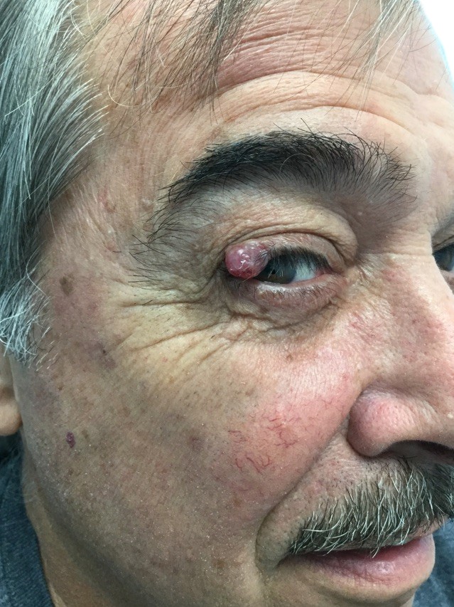 Before Eyelid Reconstruction