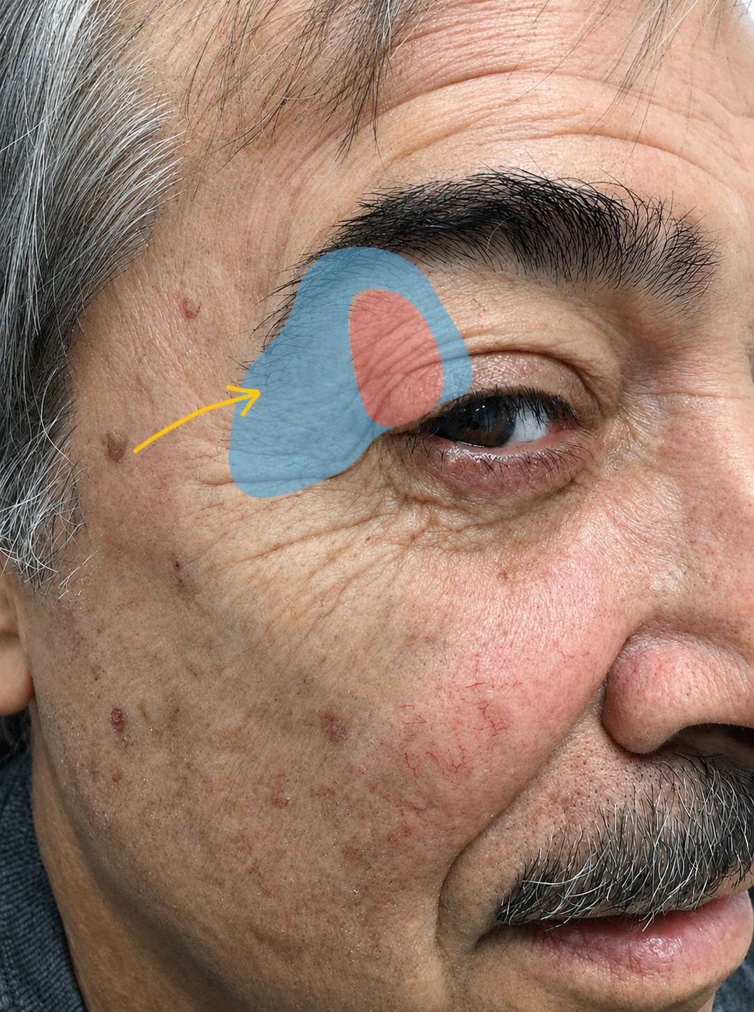 Educational reconstruction overlay for Eyelid Reconstruction