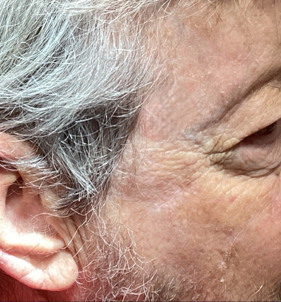 After Eyelid & Facial Reconstruction