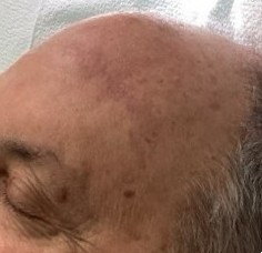 After Facial Reconstruction