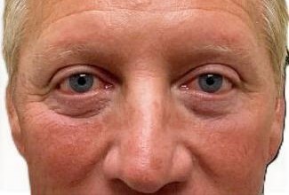 After Upper Blepharoplasty