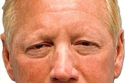 Before Upper Blepharoplasty