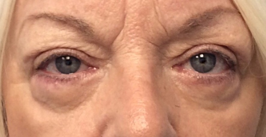 After Upper Blepharoplasty