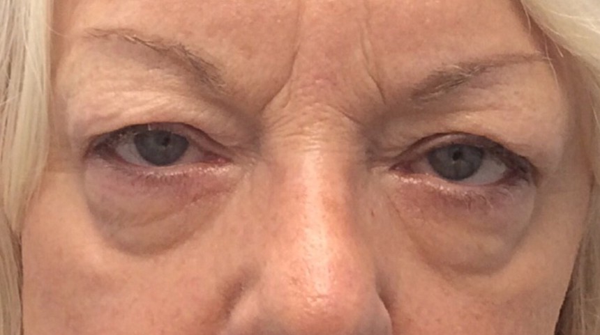 Before Upper Blepharoplasty