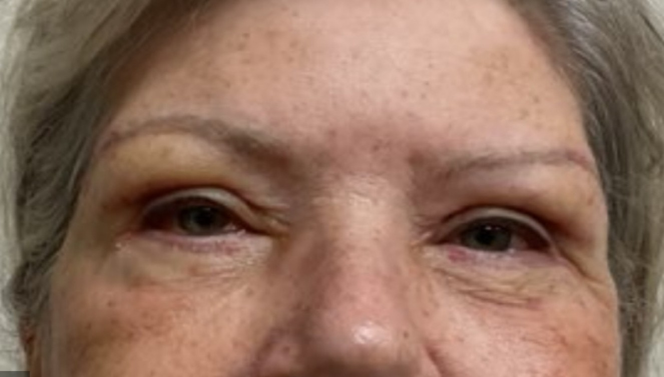 After Upper Blepharoplasty