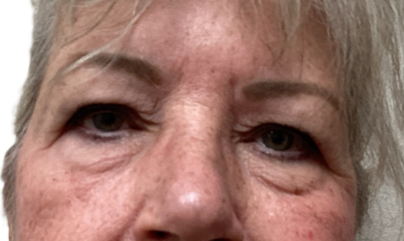 Before Upper Blepharoplasty