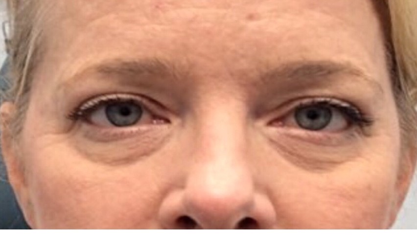After Upper Blepharoplasty