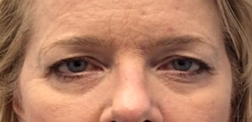 Before Upper Blepharoplasty