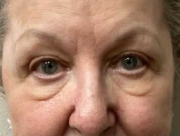 After upper blepharoplasty