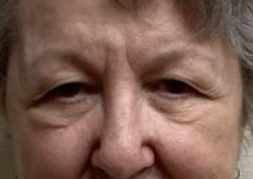 Before upper blepharoplasty
