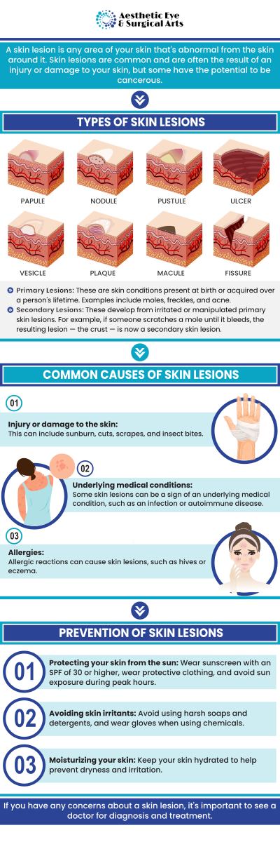 At Aesthetic Eye & Surgical Arts, Dr. Paul Brannan specializes in the removal of facial skin lesions. Dr. Brannan has a unique understanding of the delicate structures of the face, especially around the eyes. He performs the removal with a focus on both achieving a clear margin for medical purposes and ensuring the best possible cosmetic outcome. For more information, contact us or schedule an appointment online. We are conveniently located at 5310 Clark Rd Suite 106, Sarasota, FL 34233.